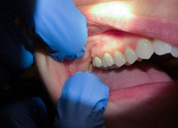 Best Urgent Care for Lost Fillings or Crowns in Walkertown, NC