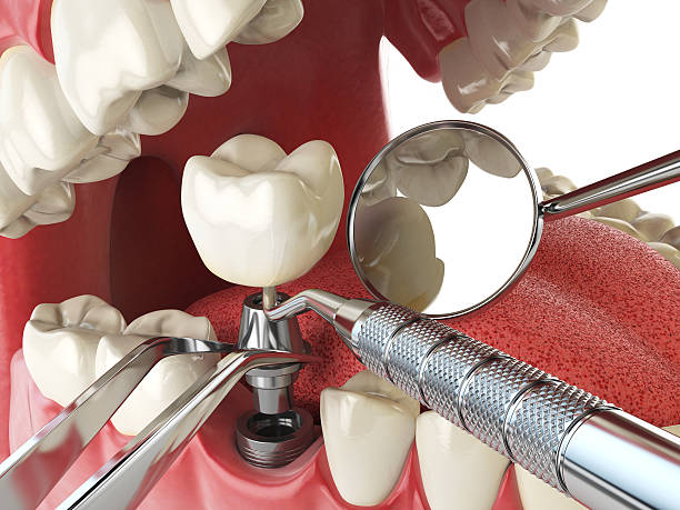 Best Emergency Root Canal Treatment in Walkertown, NC